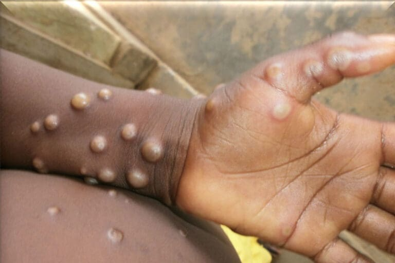 Nigeria yet to announce date for Mpox vaccinations rollout — Africa CDC Mpox